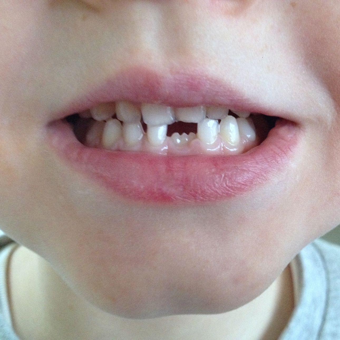 Tandsæt med ny fortand på vej