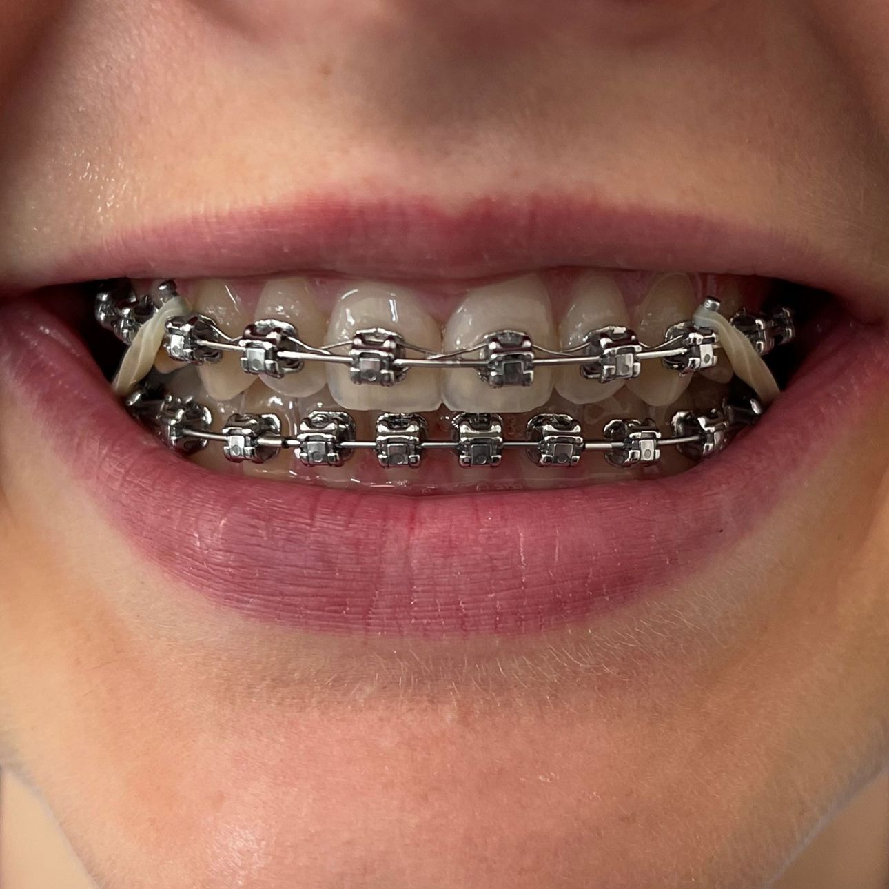 Tænder med fast bøjle på